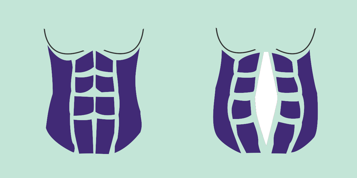 Dijastaza trbušnih mišića: Detaljan vodič